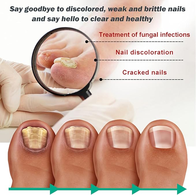 Nexusdrop Nail Fungus Solution