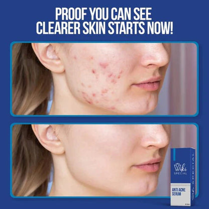 Wiki Special Anti Acne Serum - 30ml